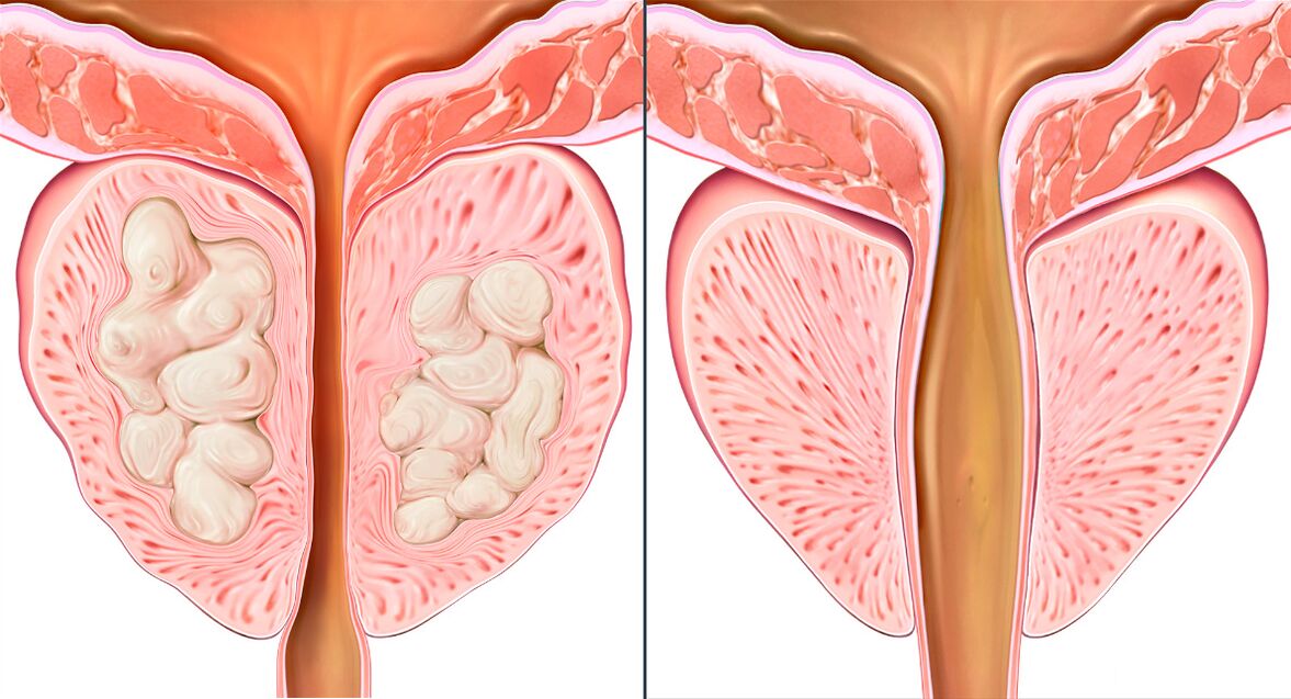 Stadia van de behandeling van prostatitis met Prostalix